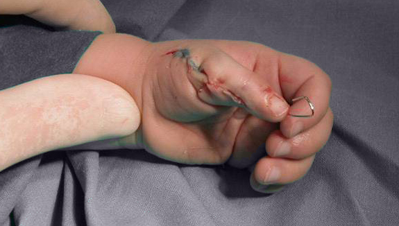 Preaksial polydactyly - one day after surgery